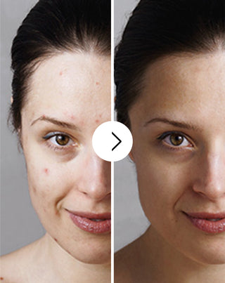 Acne, borbulhas e imperfeições em comprimidos com zinco, vitamina C, E e B2 Derminax_3 - 3