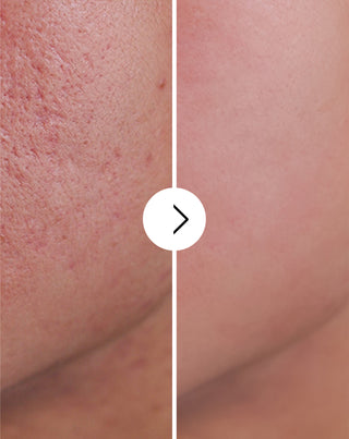 Acne, borbulhas e imperfeições em comprimidos com zinco, vitamina C, E e B2 Derminax_4 - 4