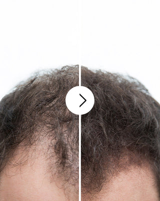 Cápsulas para a queda de cabelo com efeito espessante e fortificante Follixin 60 cápsulas - 6