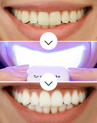 Kit de branqueamento dentário com lâmpada LED e gel de branqueamento Light & Bright Smilebite - 3